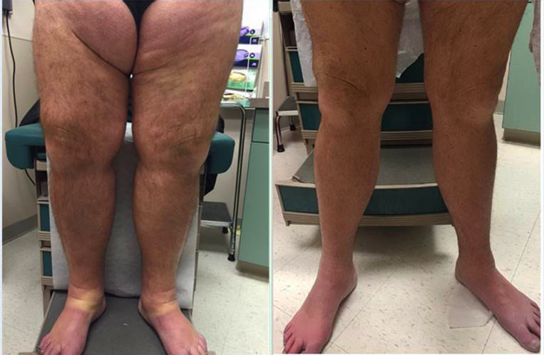 man with swollen legs before canalization of the deep veins and with normal-sized legs after the procedure